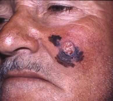 Melanoma Guancia