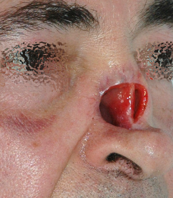 Carcinoma Spinocellulare Naso - Ricsotruzione Naso