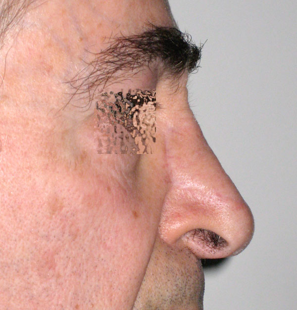 Carcinoma Spinocellulare Naso - Ricsotruzione Naso