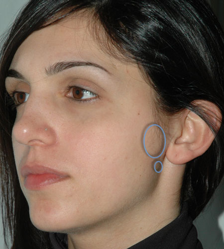Adenoma Pleomorfo Parotide - Recidiva