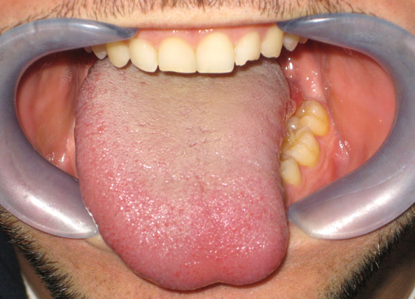 Carcinoma Spinocelllulare Lingua