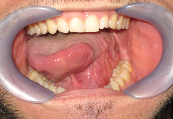 Carcinoma Spinocelllulare Lingua