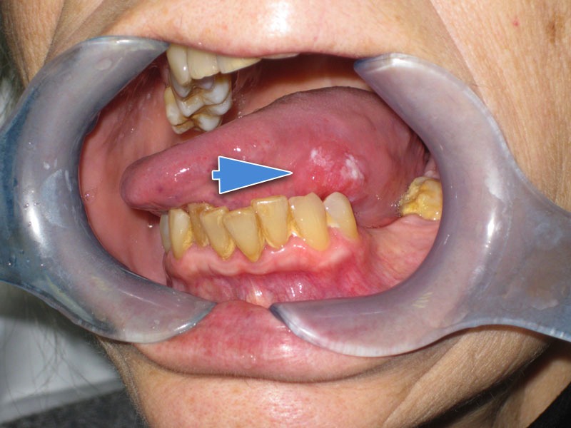 Carcinoma Spinocelllulare Lingua