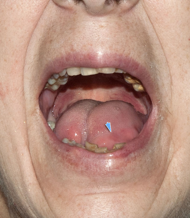 Carcinoma Spinocelllulare Lingua