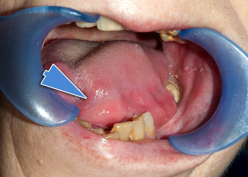 Carcinoma Spinocelllulare Lingua