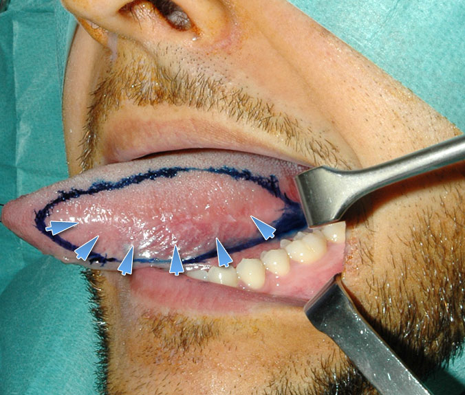 Carcinoma Spinocelllulare Lingua