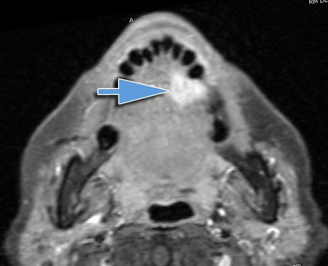 Carcinoma Spinocelllulare Lingua