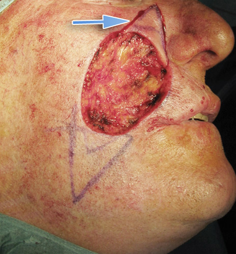 MelanomaGeneraleIntra1
