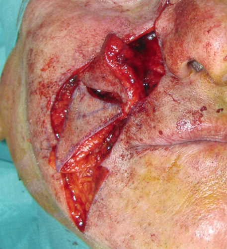 MelanomaGeneraleIntra2