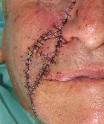 MelanomaGeneraleIntra3