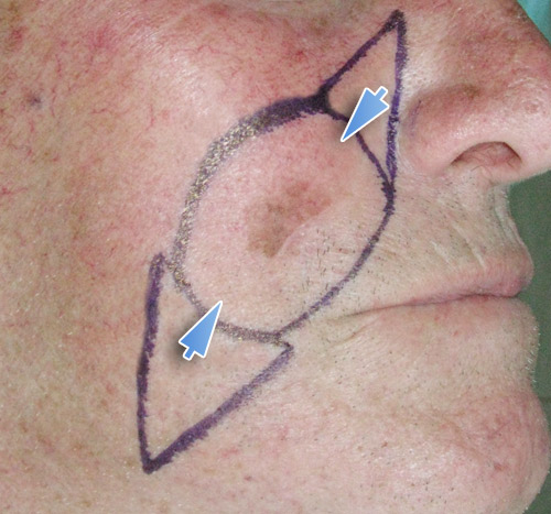 Melanoma della Guancia