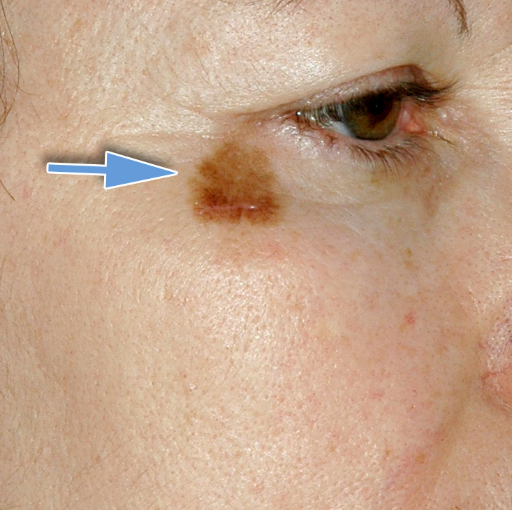 Melanoma della Palpebra